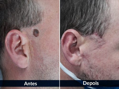 Antes do tratamento de câncer de pele