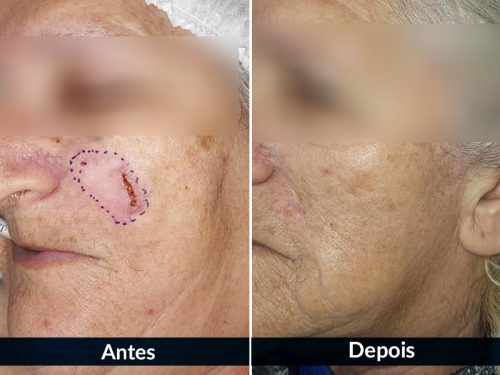 Depois do tratamento de câncer de pele