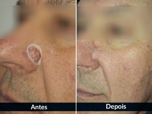 Antes da cirurgia de Mohs