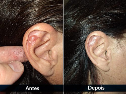 Depois da cirurgia de Mohs