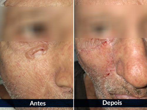 Resultado estético após remoção de tumor de pele