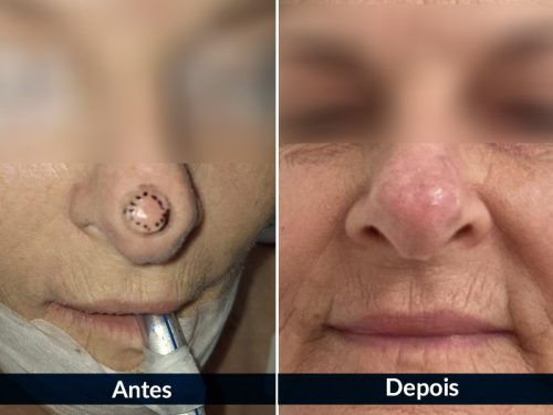 Pós-operatório de câncer de pele