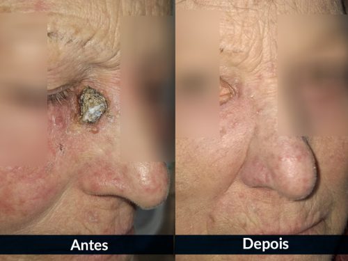 Cicatriz minimizada após tratamento